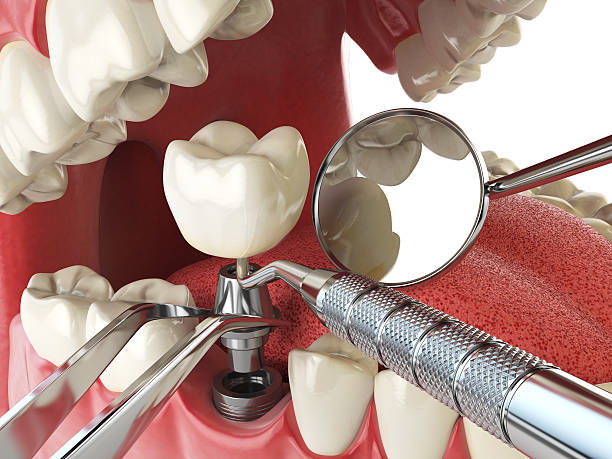 Best Lost Filling or Crown Replacement in Greensboro, GA